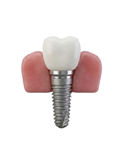 Implantes Dentários